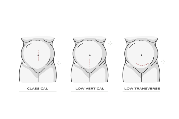 Cesarean Section