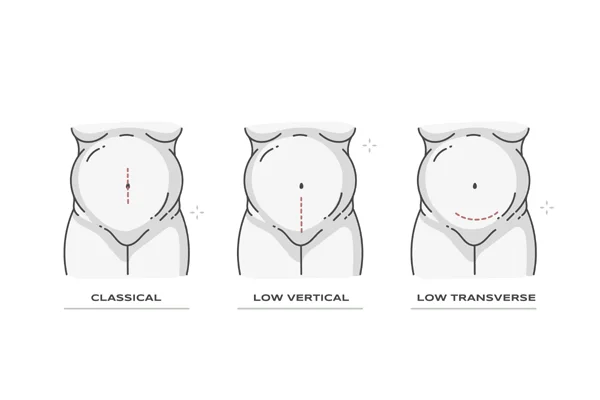 Cesarean Section